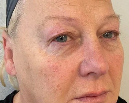 Double Chin Reduction