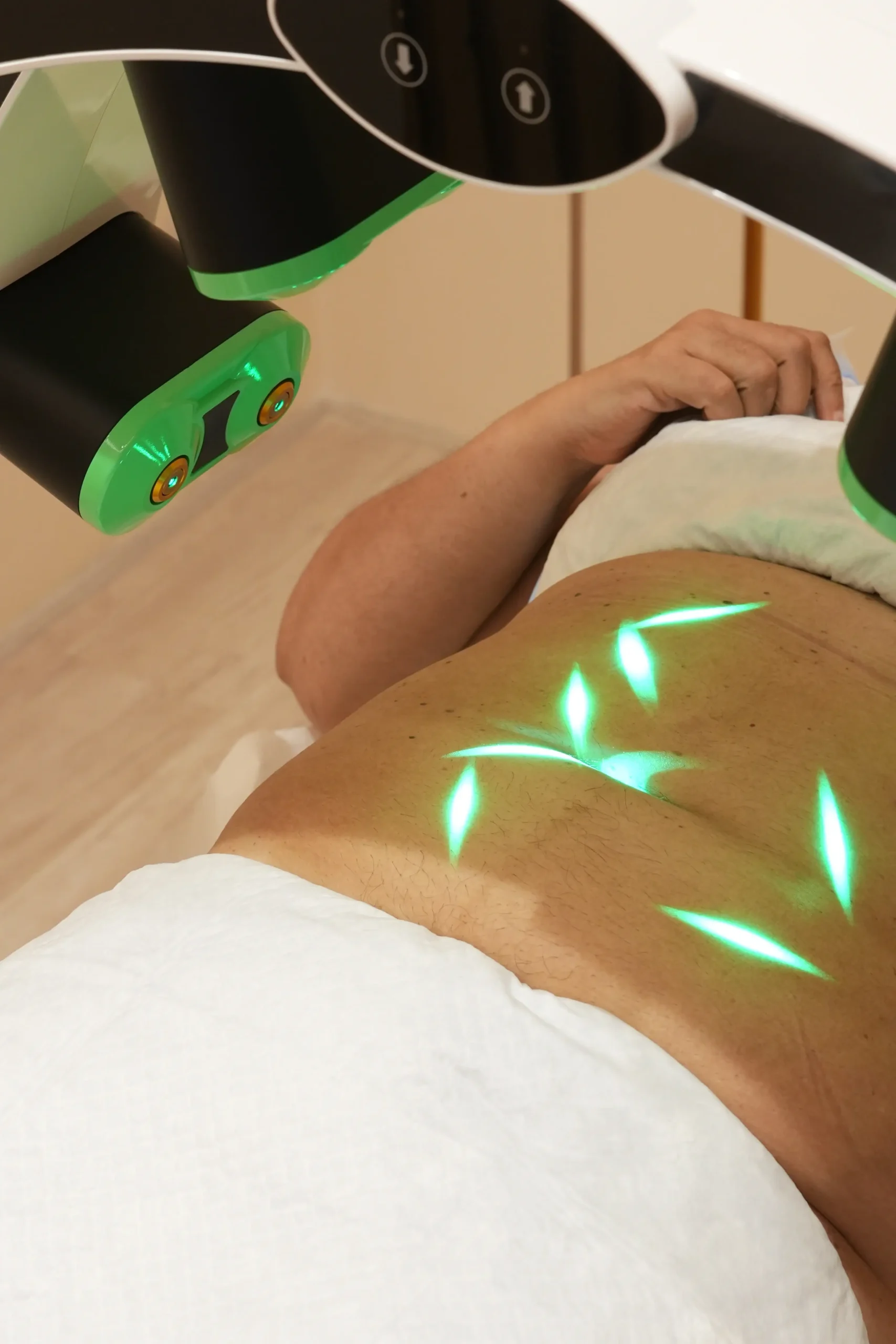 Laser treatment on a person's abdomen