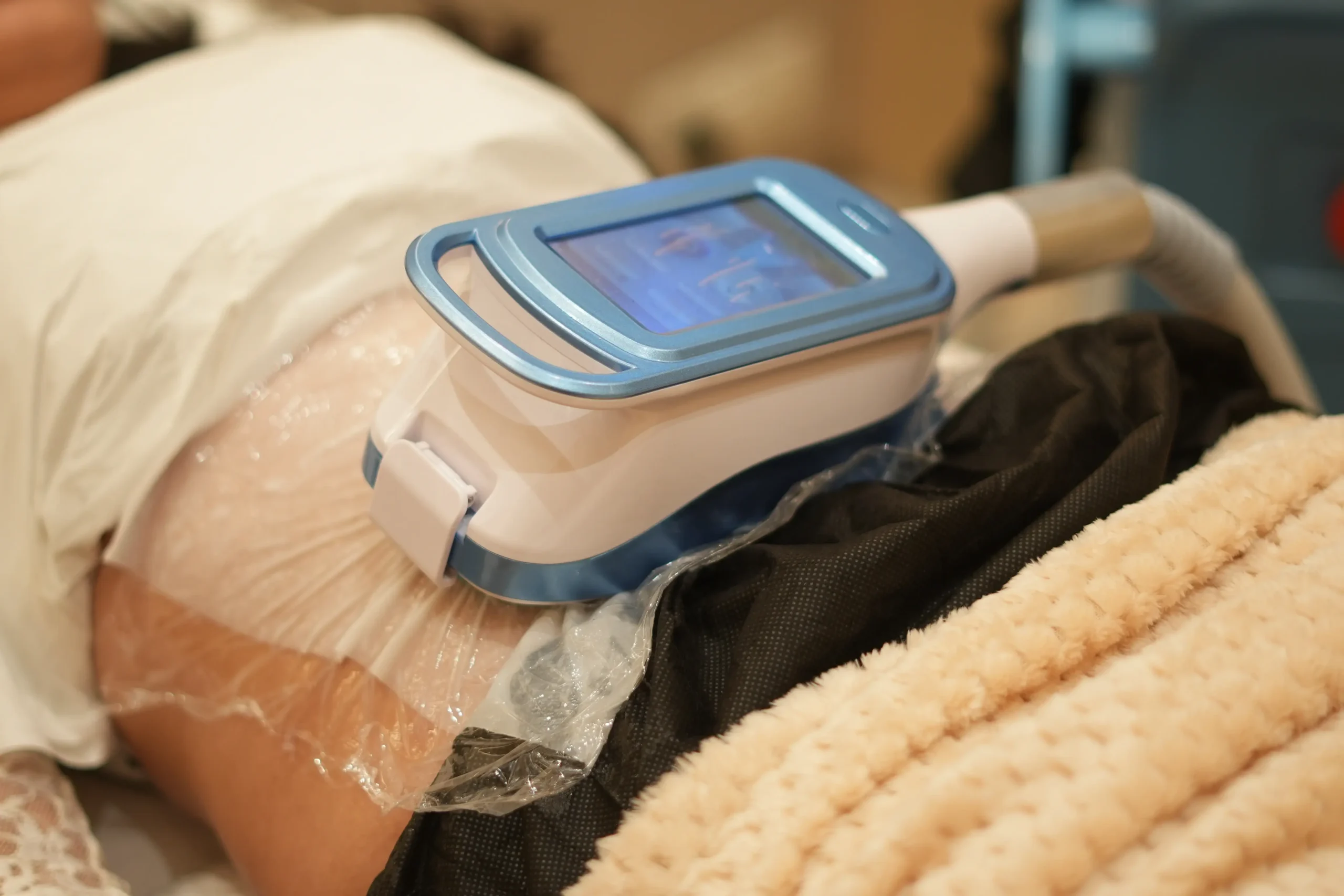 Fat freezing treatment applied to the back for fat reduction at Vivo Body and Skin Clinic.