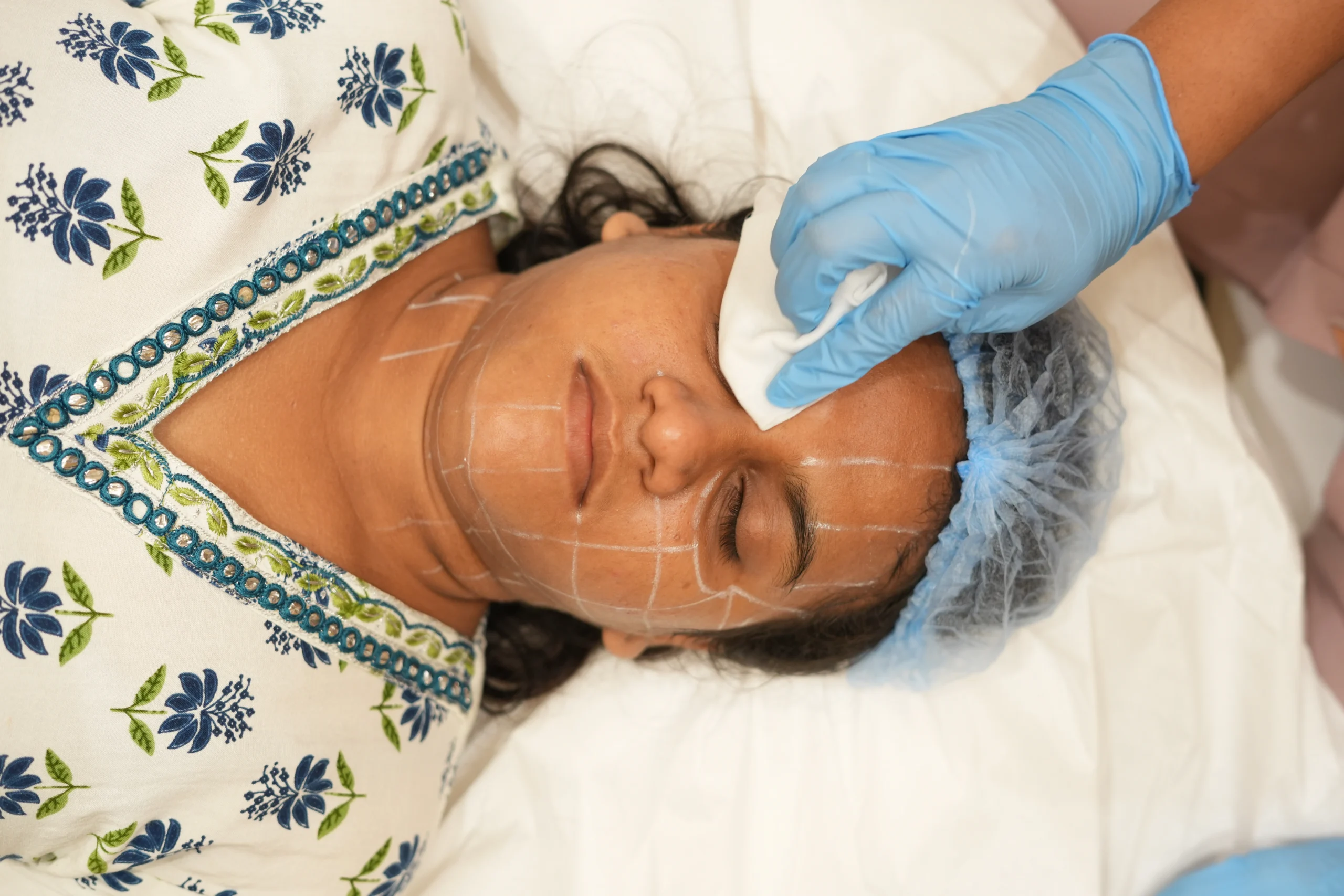HIFU Facelift: The Non-Surgical Lift You Need at Vivo Body & Skin Clinic Mumbai 3 HIFU Facelift