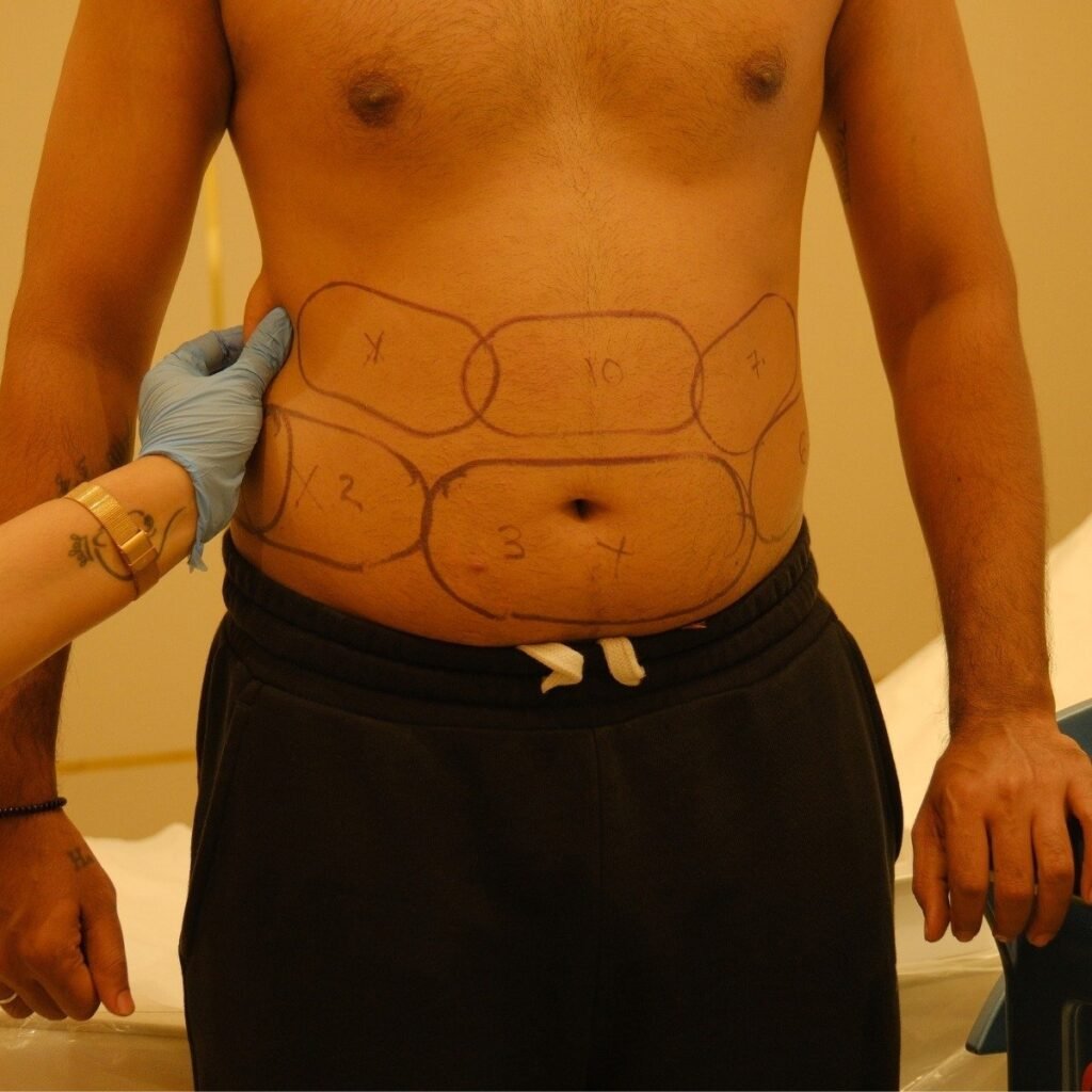 Marking areas on the abdomen for Fat Freezing (Cryolipolysis) treatment at Vivo Body & Skin Clinic. Targeting specific fat zones for non-surgical body contouring.