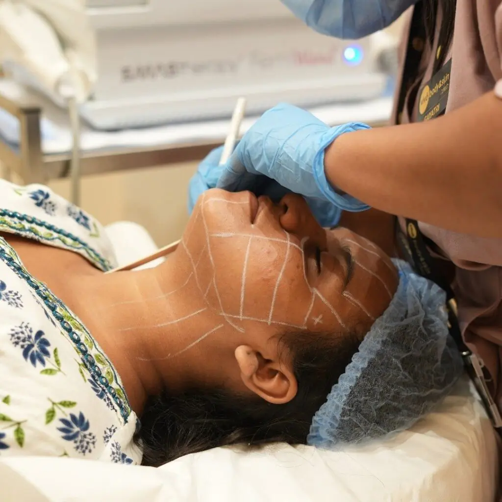 HIFU Facelift treatment in progress at Vivo Body & Skin Clinic, marking areas on the face for non-invasive skin tightening and lifting.