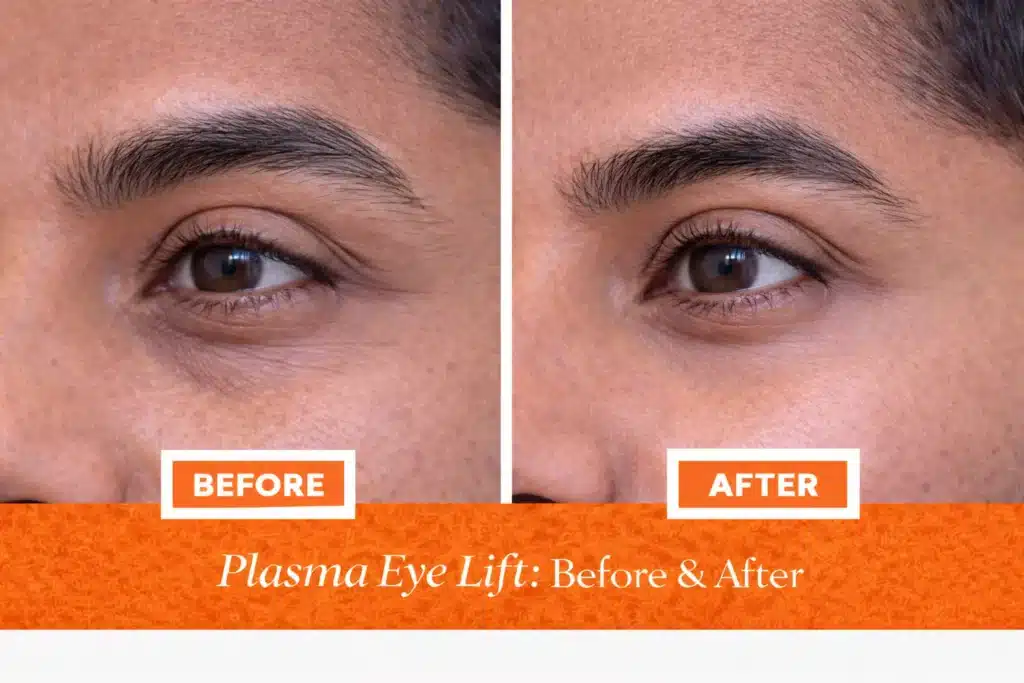 plasma eye lift before & after men image