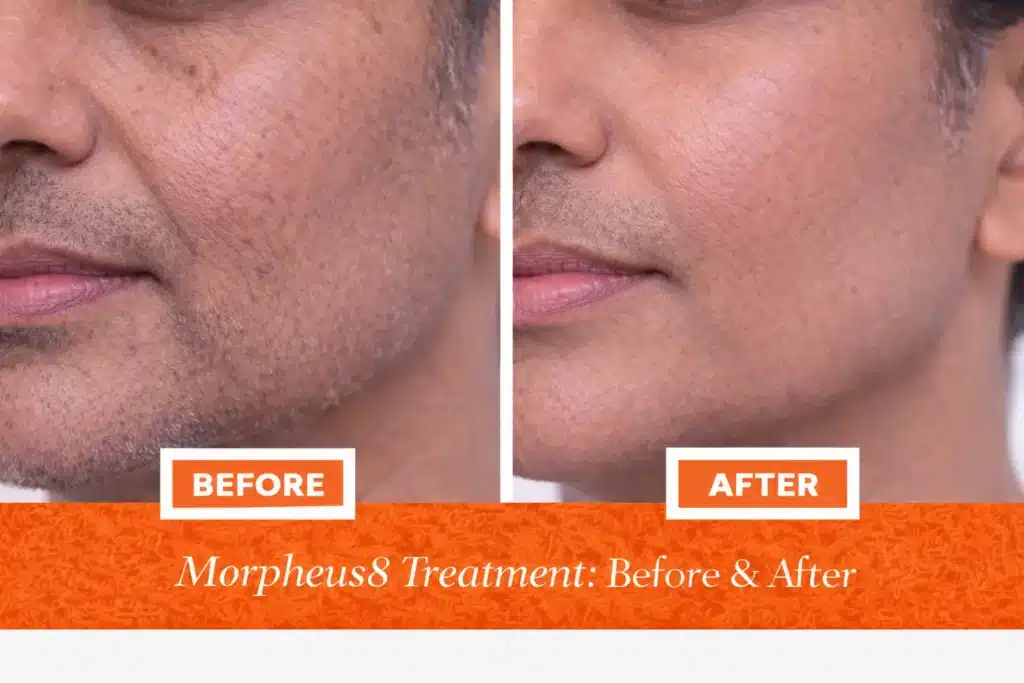 Before and after Morpheus8 treatment showing smoother skin, reduced acne marks, and improved jawline firmness in Indian male