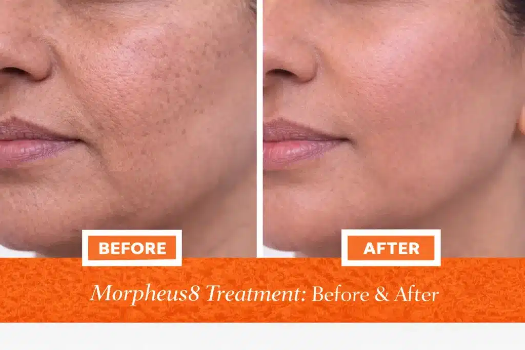 Before and after Morpheus8 treatment showing improved skin texture, reduced pigmentation, and firmer facial skin in Indian woman