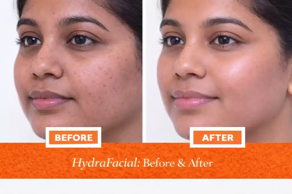 HydraFacial before and after comparison of Indian man showing improved skin texture, refined pores, and enhanced glow