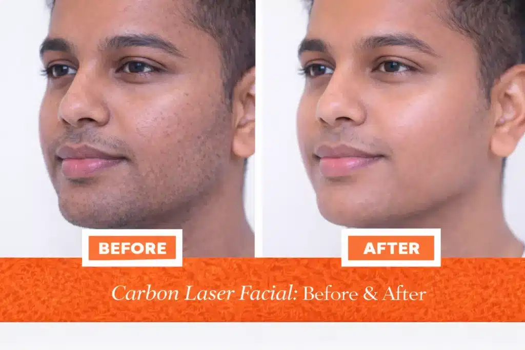 Before and after Carbon Laser Facial treatment showing clearer skin, refined pores, and improved skin tone in Indian male patient.