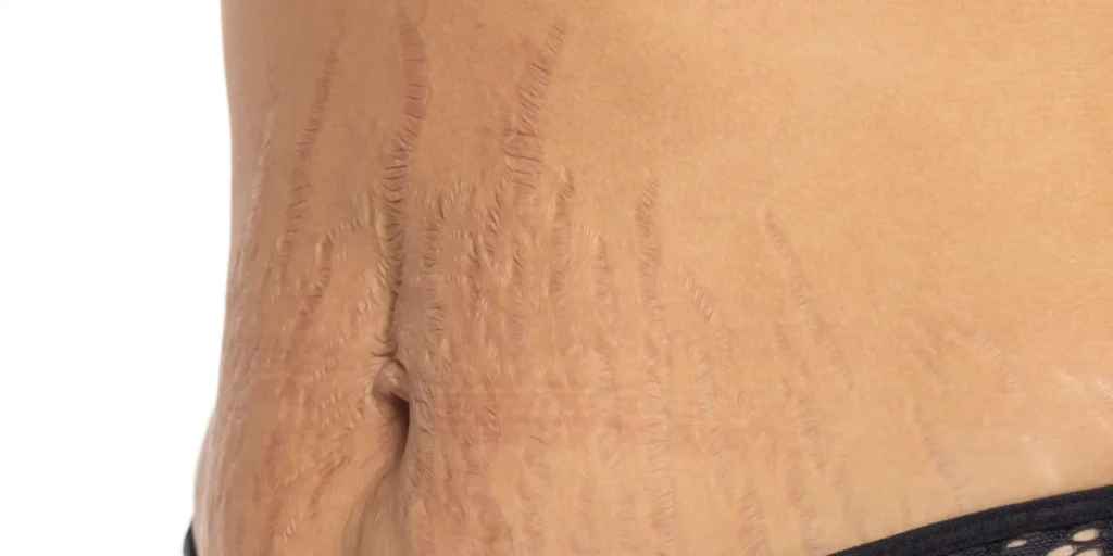 A close-up view of stretch marks on the skin, treated with advanced methods for reducing their appearance at Vivo Body & Skin Clinic in Mumbai.