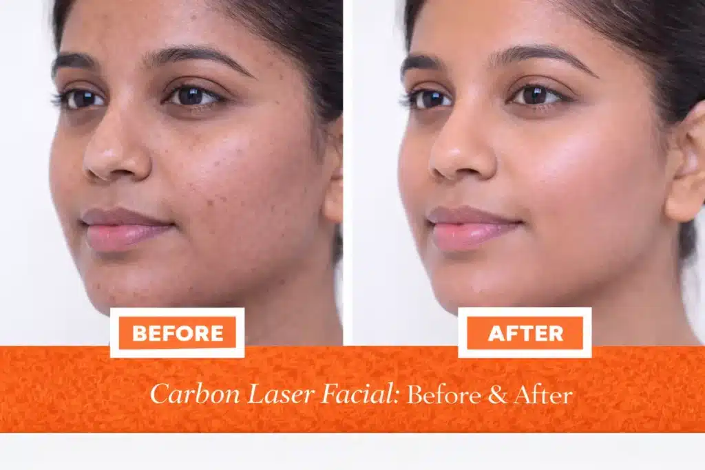 Carbon Laser Facial Before and After Results – Skin Brightening & Pore Reduction Treatment