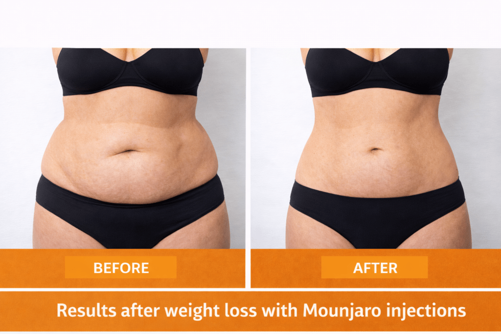 Before and after Mounjaro weight loss injections Treatment