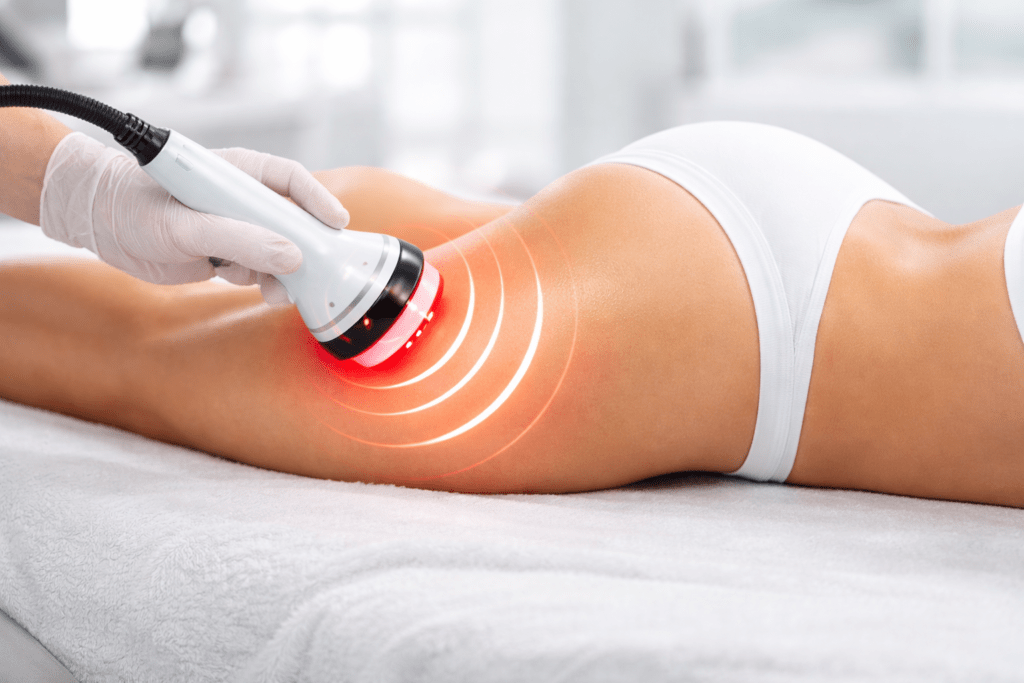 a client having cellulite reduction treatment at vivo body & skin Clinic mumbai