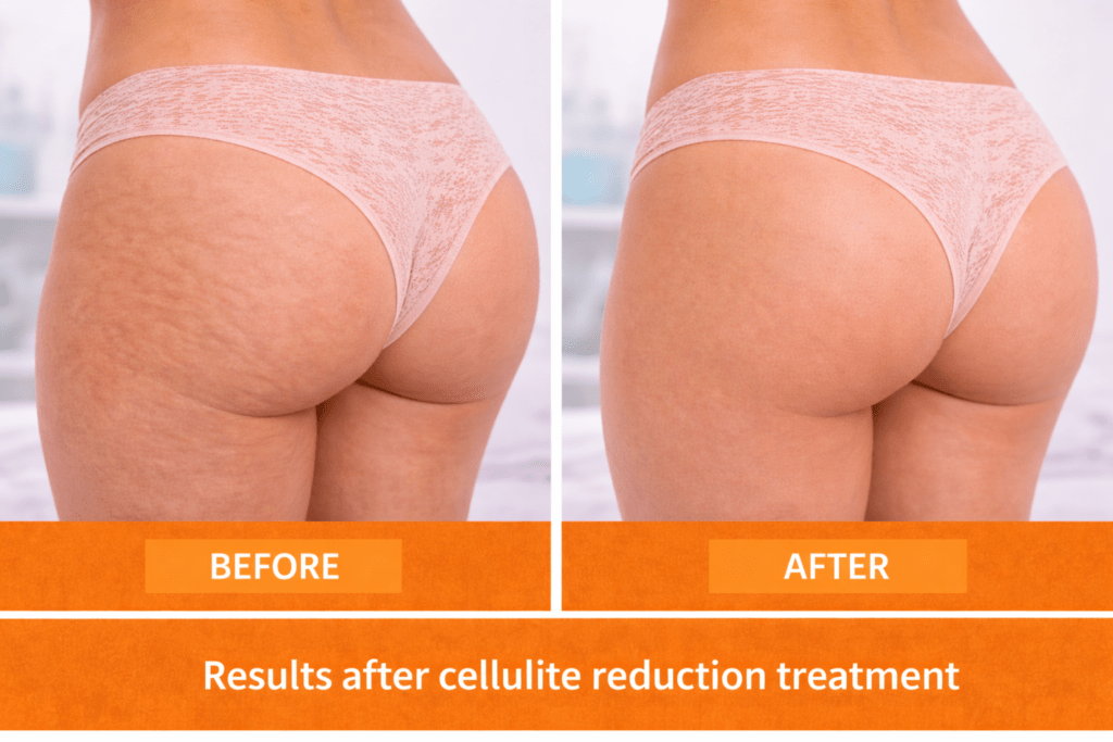 Before and after cellulite removal treatment at Vivo Body & Skin Clinic showing visible improvement in skin texture and reduced thigh cellulite.