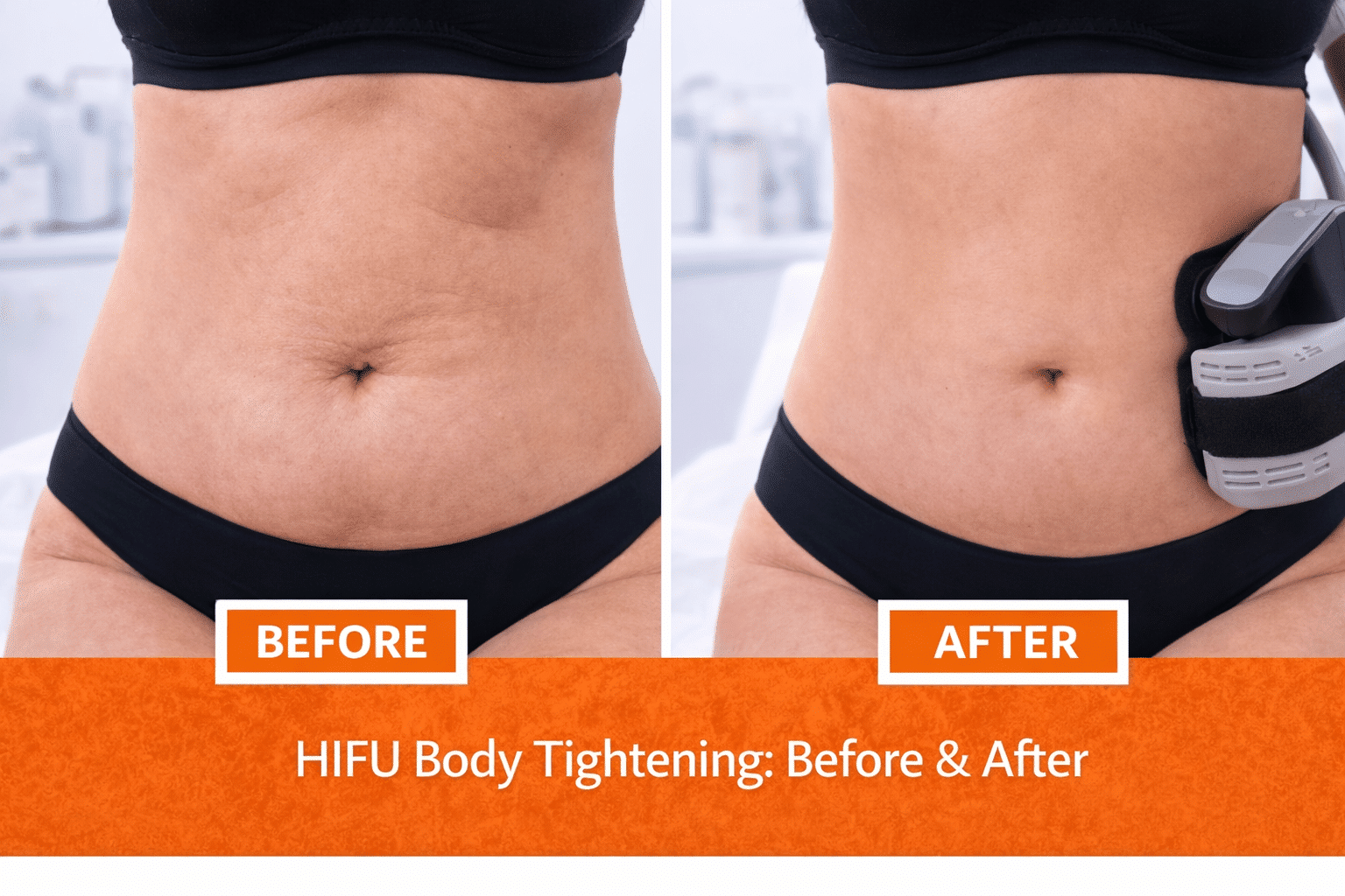 Before and after HIFU body tightening treatment showing firmer abdominal skin and improved contour using non-surgical ultrasound technology