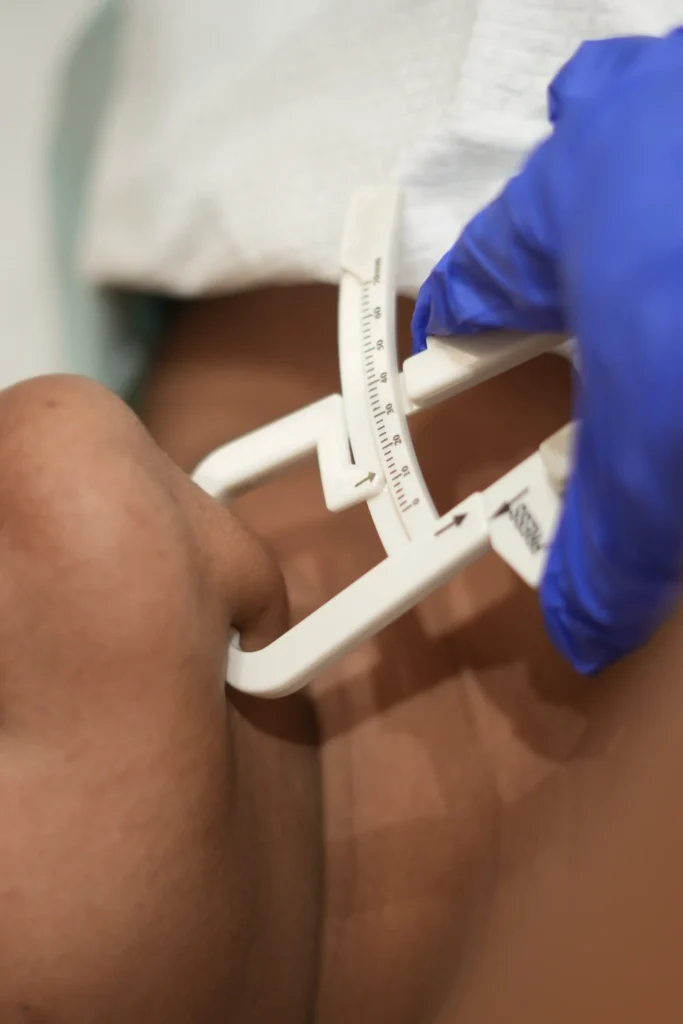 A client having Double Chin Measurement for Fat Reduction at Vivo Body & Skin Clinic, Mumbai