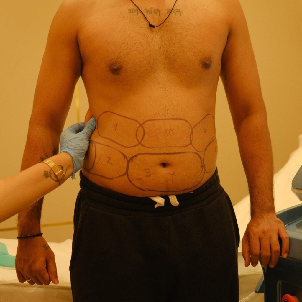 Fat Reduction Treatment at Vivo Body & Skin Clinic