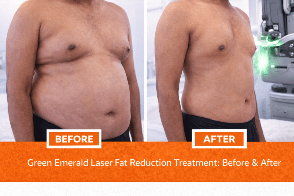 Before and after Green Emerald Laser fat reduction treatment showing reduced belly fat and more defined waistline