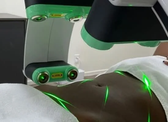 A client receiving Green Emrabel Laser treatment for fat reduction at Vivo Body & Skin Clinic in Mumbai, with the laser technology targeting stubborn fat in the abdominal area.