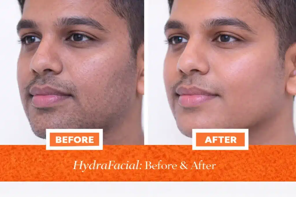 Before and after HydraFacial treatment showing brighter, hydrated, and smoother skin with reduced pores in Indian male patient.