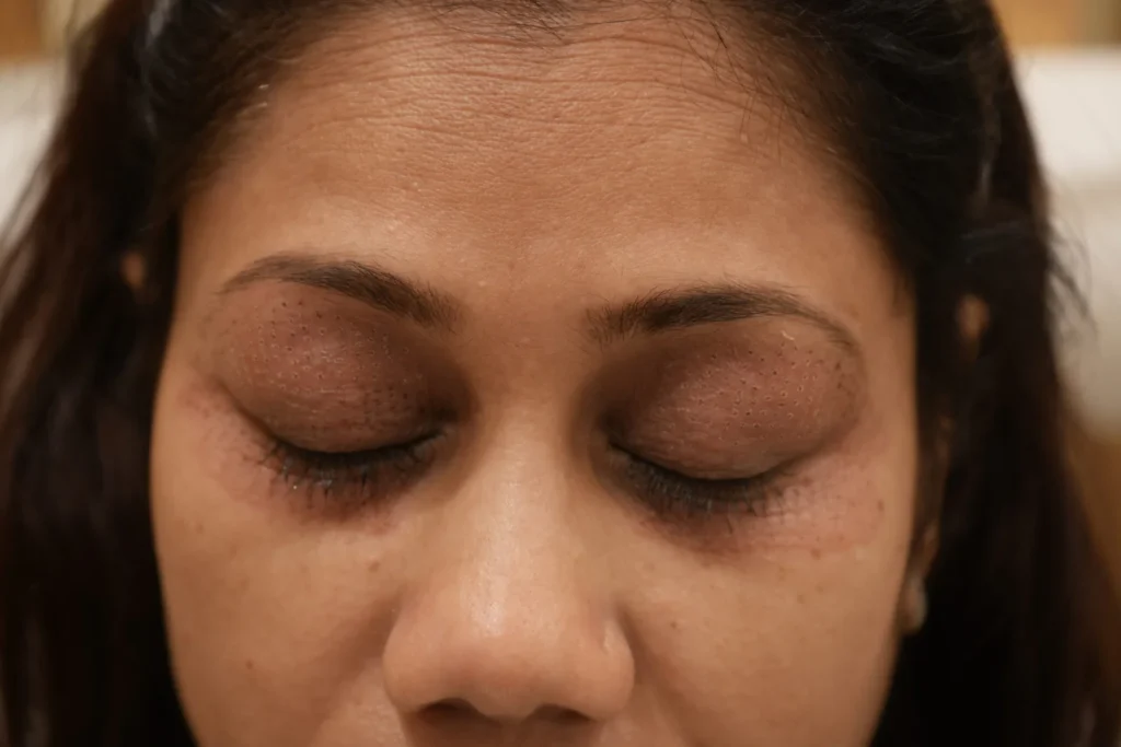 A close-up of a client undergoing microneedling treatment around the eyes at Vivo Body & Skin Clinic in Mumbai, designed to target fine lines and rejuvenate the skin.