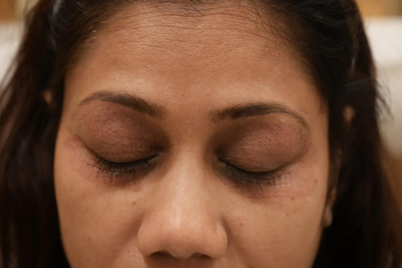 Plasma eye lift treatment being performed on the eye area at Vivo Body & Skin Clinic Mumbai