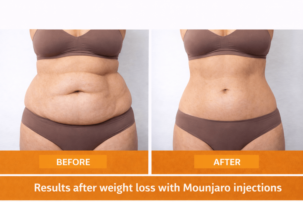 Before and after Mounjaro weight loss injections Treatment