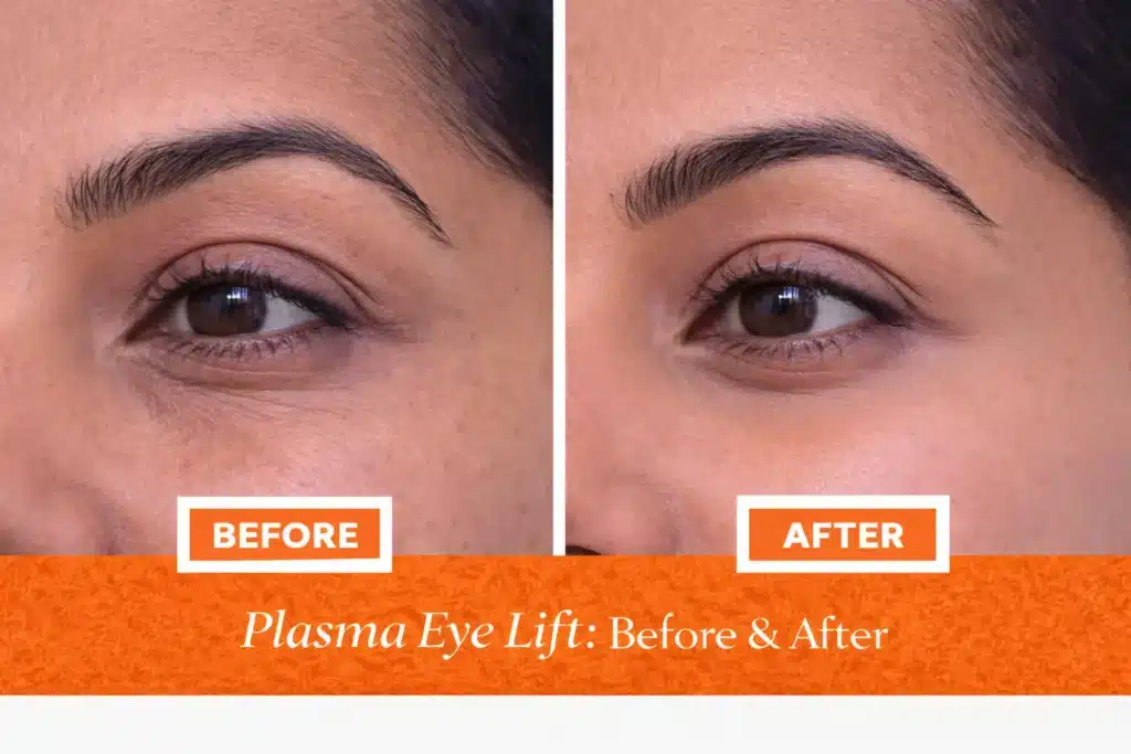 plasma eye lift before & after women
