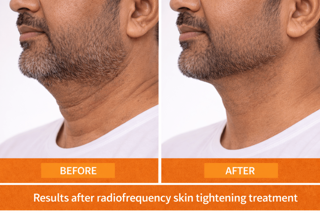 Before and after radiofrequency skin tightening at Vivo Body & Skin Clinic