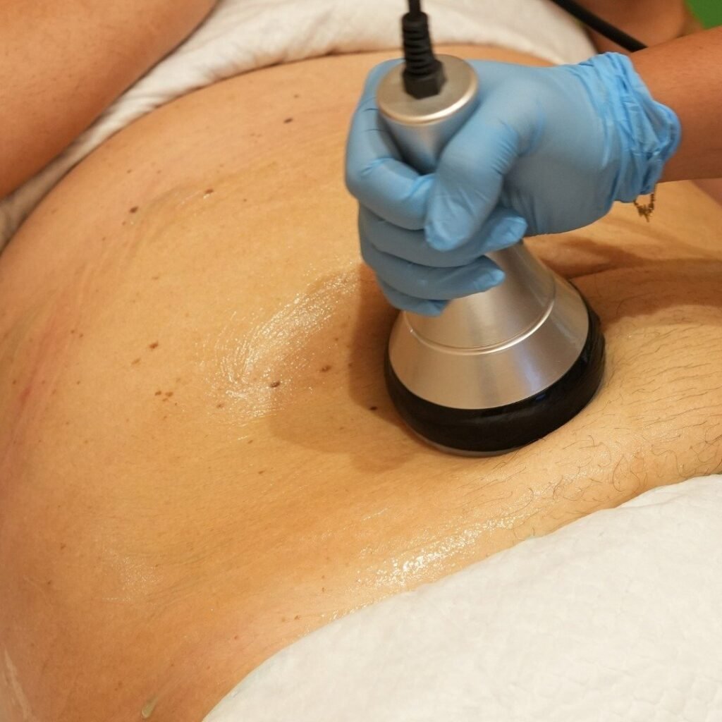 Radiofrequency Body Tightening