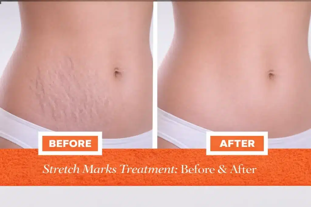 Before and after results of stretch marks treatment showing visible reduction of stretch marks and smoother abdominal skin at Vivo Body & Skin Clinic.