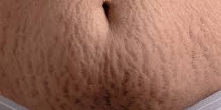 strech-marks-treatment