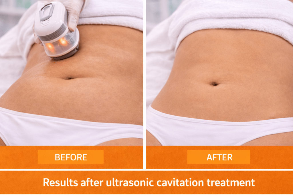 Ultrasonic Cavitation Before & After Results