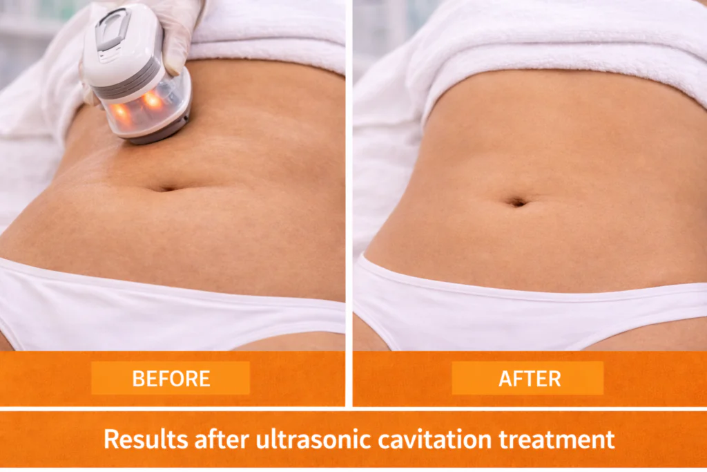 Ultrasonic Cavitation Before & After Results