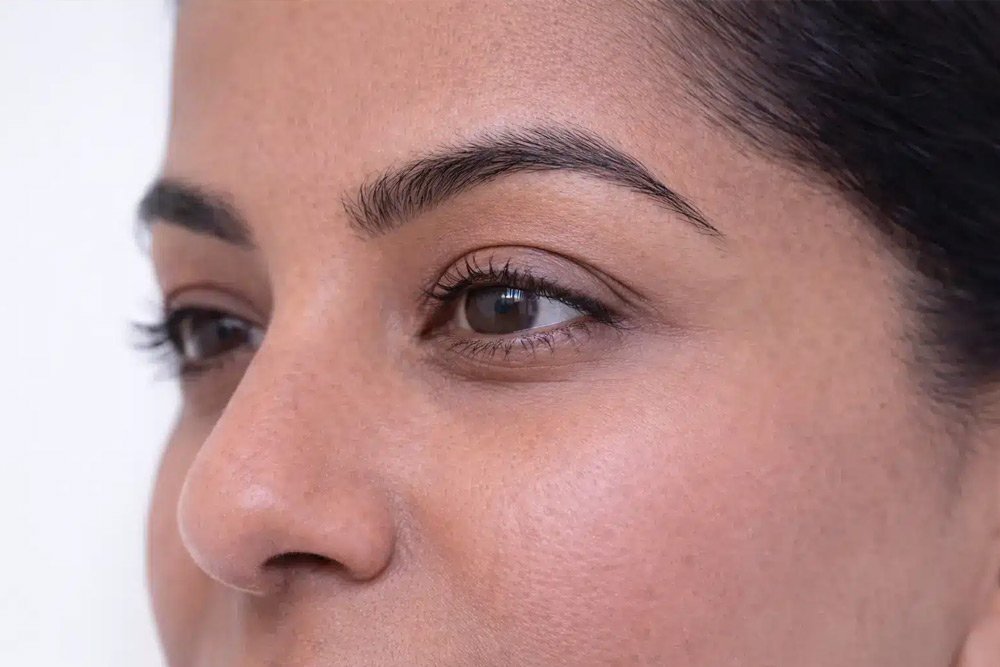 Plasma eye lift aftercare results