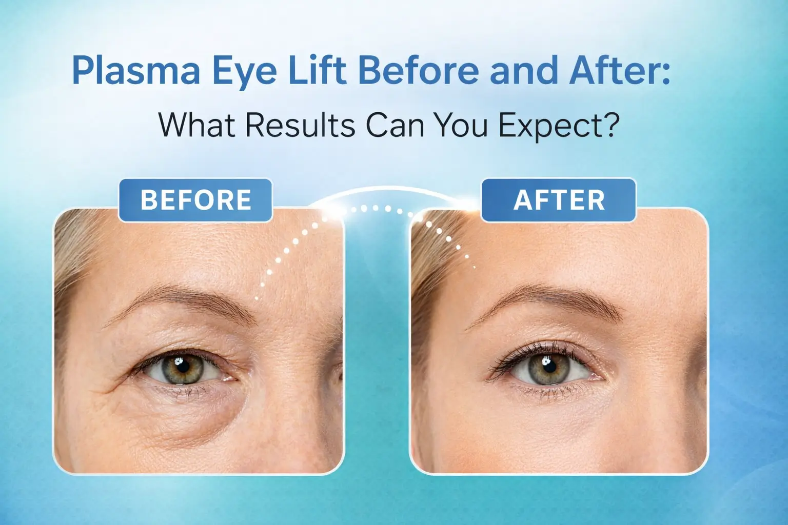 Plasma Eye Lift Before and After: What Results Can You Expect?