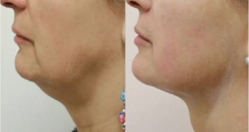 HIFU treatment India