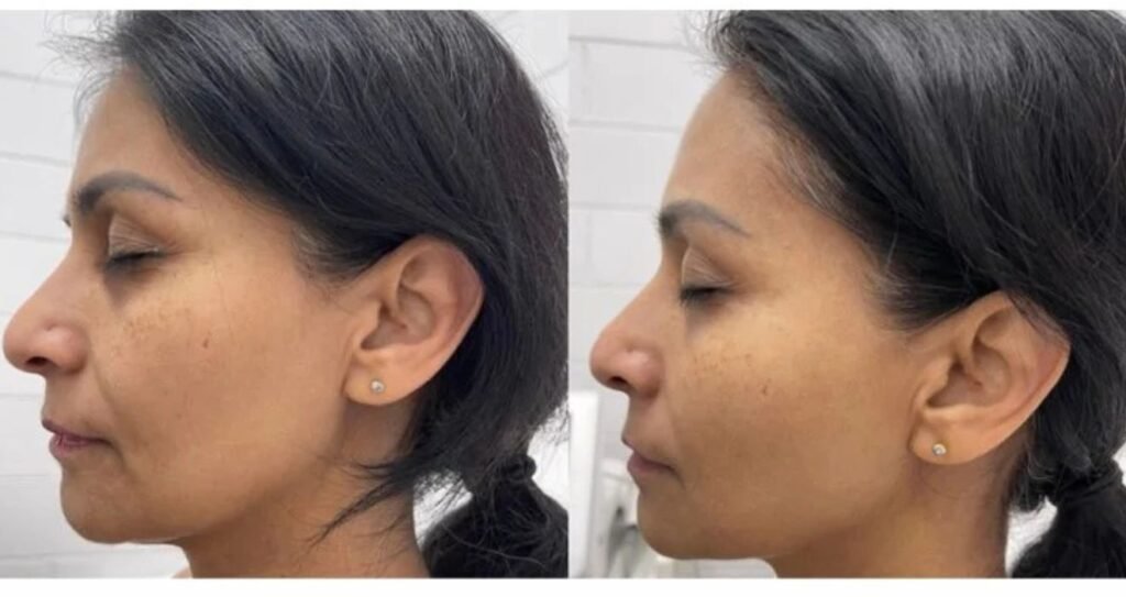 HIFU Facelift Treatment Areas: Face, Jawline, Neck & Body Comparison 4 HIFU facelift before and after jawline tightening 1