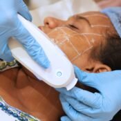 HIFU treatment for skin tightening Feature Image