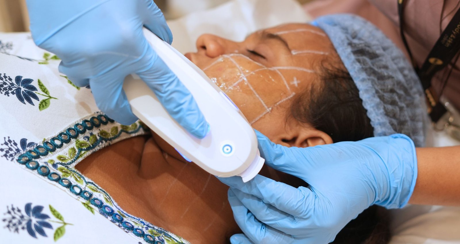 HIFU for Face & Body: Myths, Facts & Real Benefits 6 HIFU for Face & Body: Myths, Facts & Real Benefits