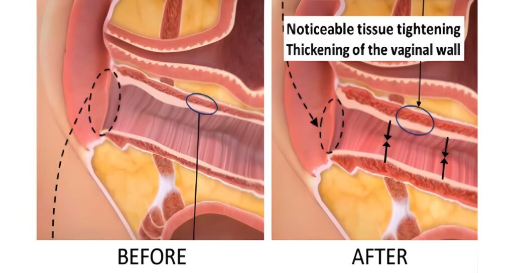 HIFU Vaginal Tightening: How It Can Improve Sensitivity, Tone & Confidence 4 efore and after results of vaginal tightening with HIFU treatment