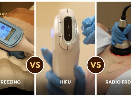 Fat Freezing vs HIFU vs RF for Body Contouring