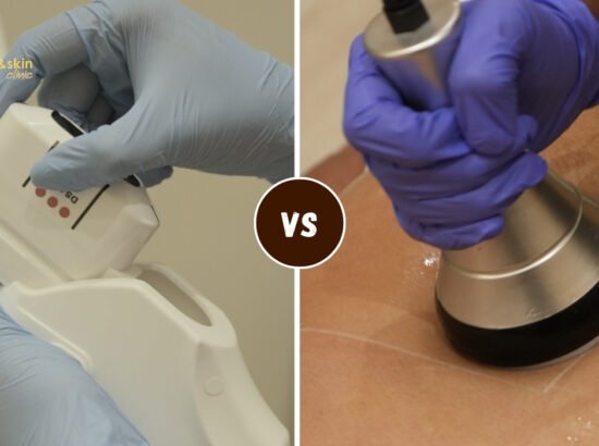 HIFU vs Ultrasound Cavitation: Which Wins for Fat Reduction?