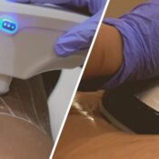 HIFU vs Ultrasound Cavitation for Body Contouring