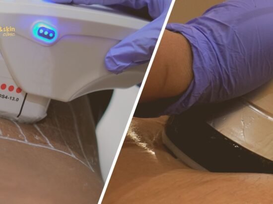 HIFU vs Ultrasound Cavitation for Body Contouring