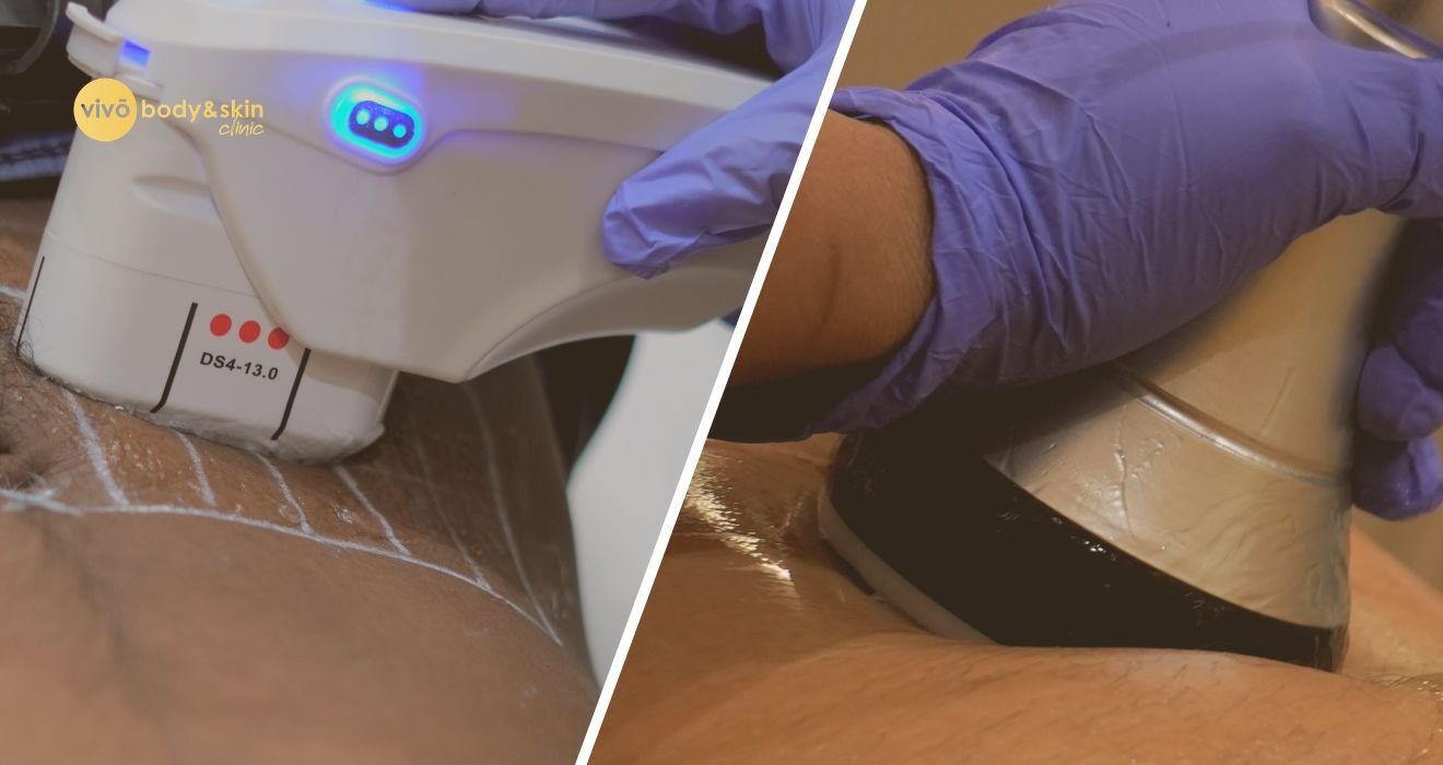 HIFU vs Ultrasound Cavitation for Body Contouring