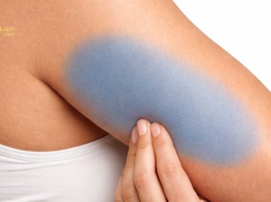 Non-Surgical Arm Fat Reduction in India: Best Treatments 2026 1 Non-Surgical Arm Fat Reduction in India: Best Treatments 2026