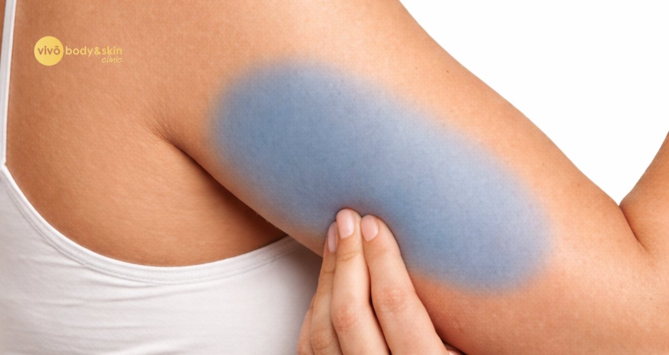 Non-Surgical Arm Fat Reduction in India: Best Treatments 2026 7 Non-Surgical Arm Fat Reduction in India: Best Treatments 2026