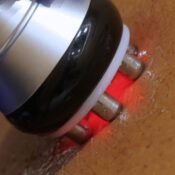 radiofrequency skin tightening for the neck