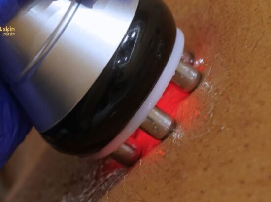 Radiofrequency Skin Tightening for the Neck: Does It Work?