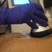 Non-Surgical Abdominal Skin Tightening India: HIFU, RF & Ultrasound