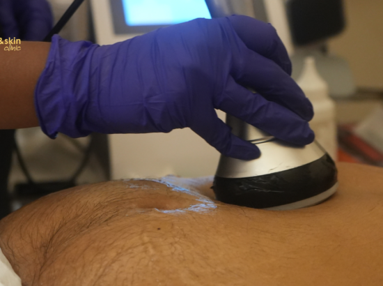 Non-Surgical Abdominal Skin Tightening India: HIFU, RF & Ultrasound